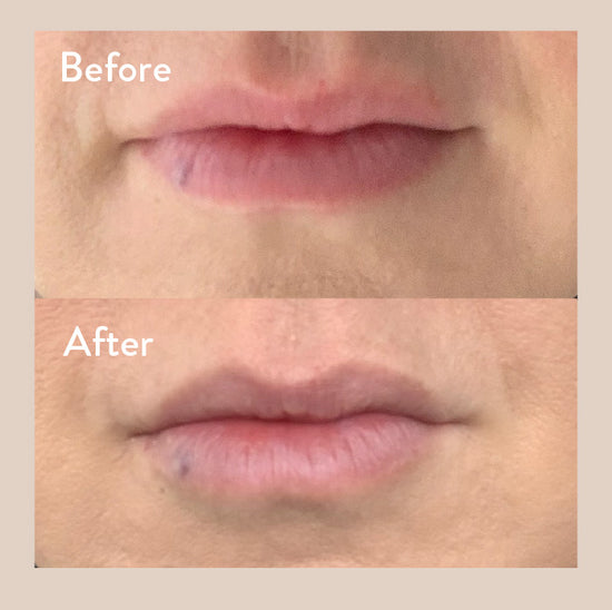 Before and after photos of a customer's lips